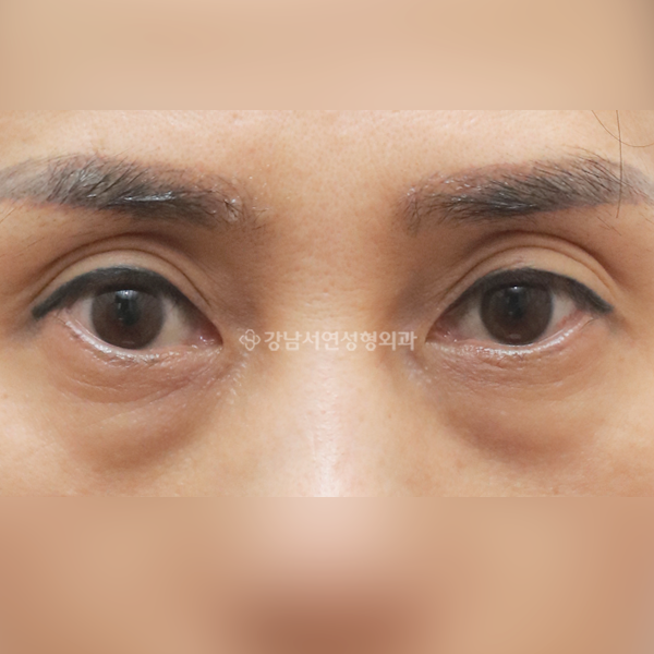하안검 BEFORE