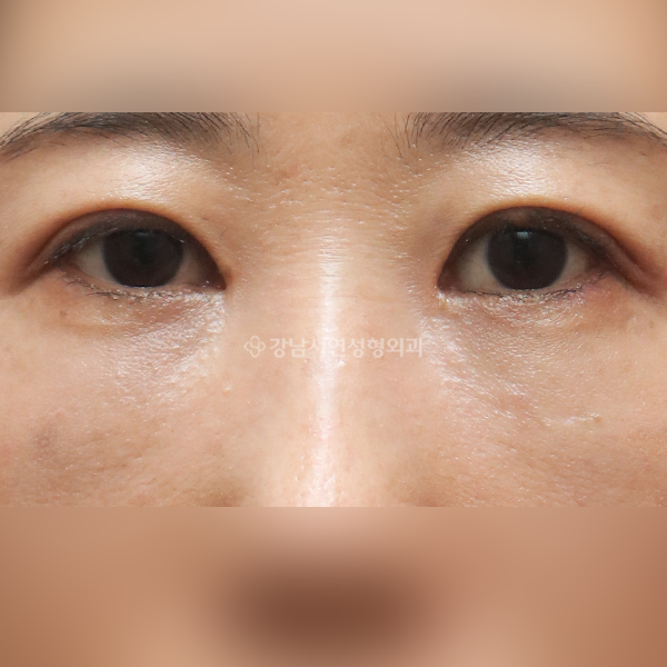 눈밑지방재배치 AFTER