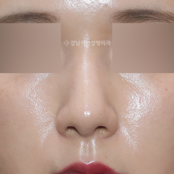 무보형물 매부리코성형 AFTER
