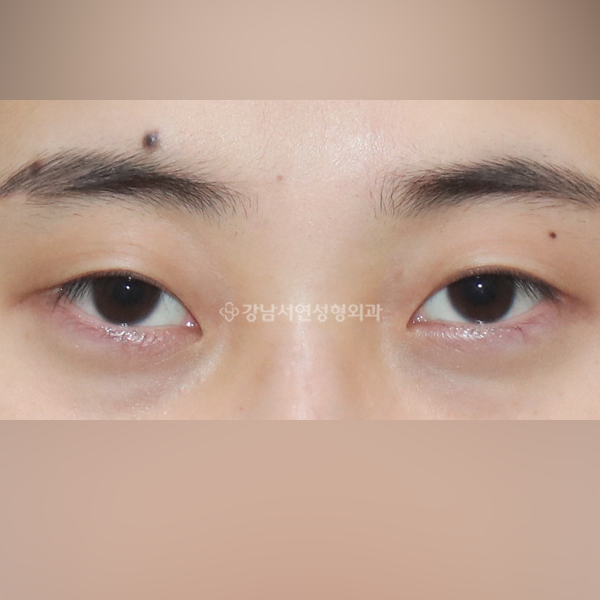 절개눈매교정+앞트임+뒷트임+밑트임 BEFORE