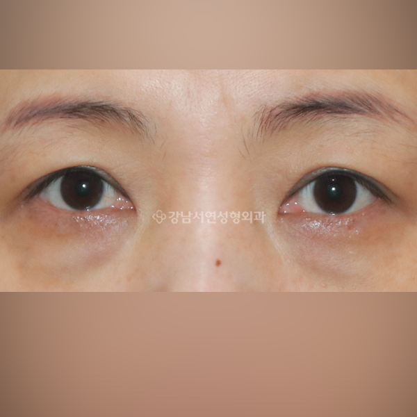 상안검+하안검 BEFORE