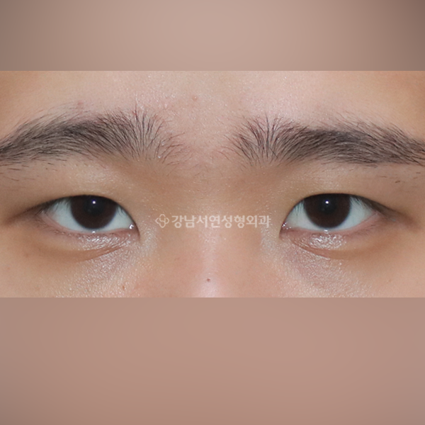 절개 쌍꺼풀 재수술 AFTER