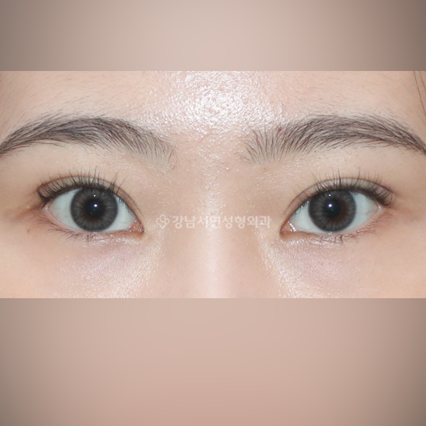 자연유착 쌍꺼풀 AFTER