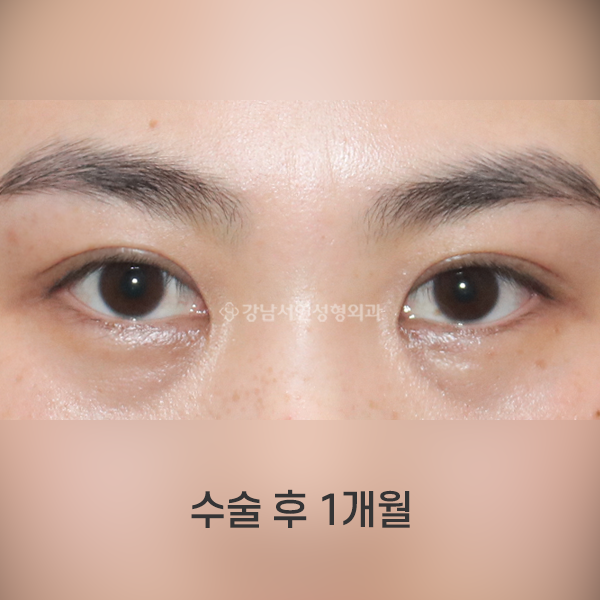 절개쌍꺼풀+앞트임 AFTER