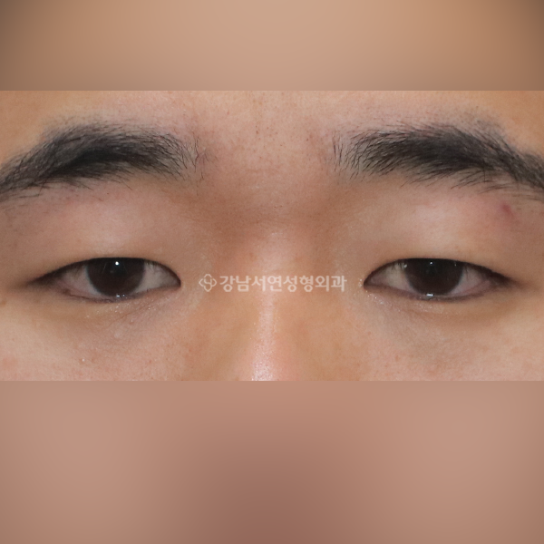 절개눈매교정 BEFORE