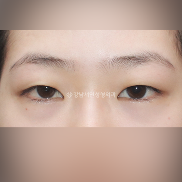 절개눈매교정 BEFORE