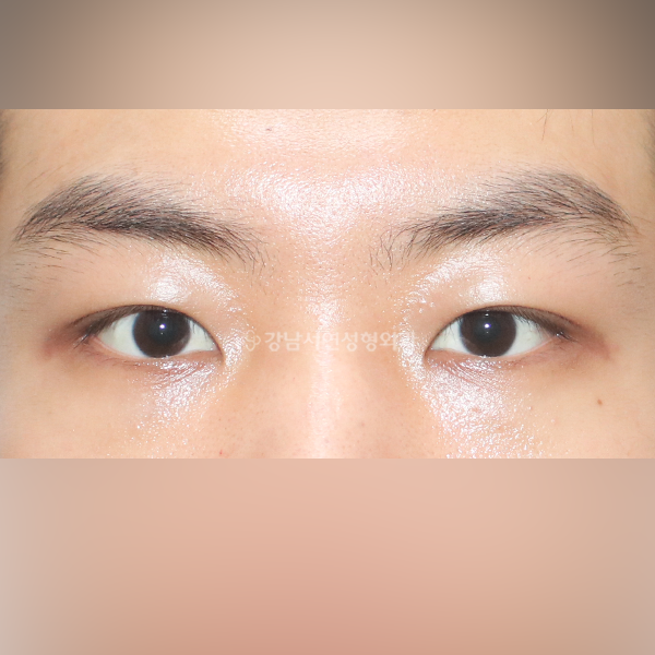 절개눈매교정 AFTER