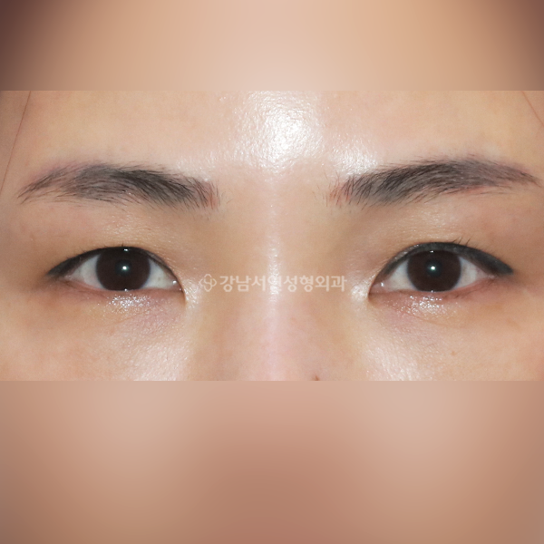 상안검 재수술+앞트임 BEFORE