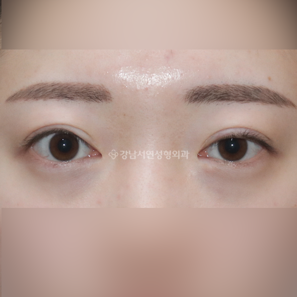 쌍꺼풀 재수술+안검퇴축+두줄따기 BEFORE