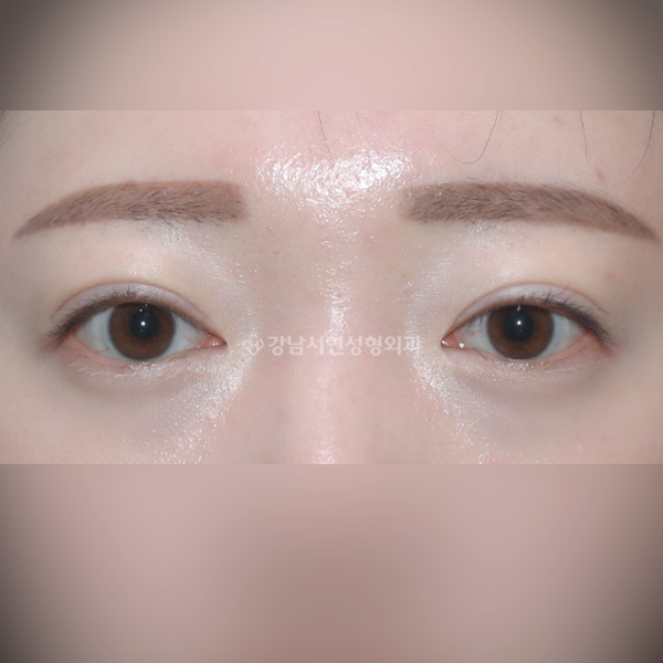 쌍꺼풀 재수술+안검퇴축+두줄따기 AFTER