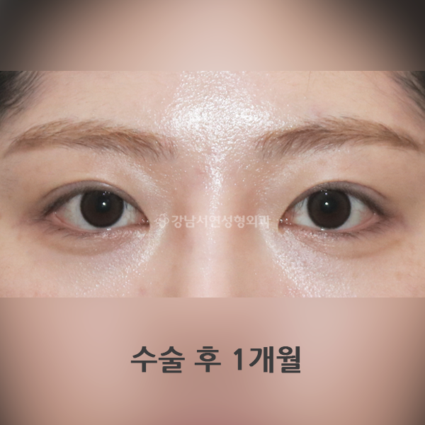 라인낮추기 재수술 AFTER