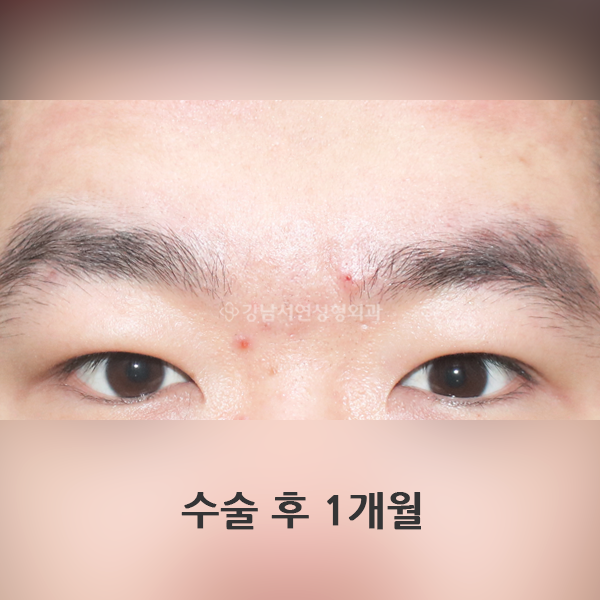 절개눈매교정 AFTER
