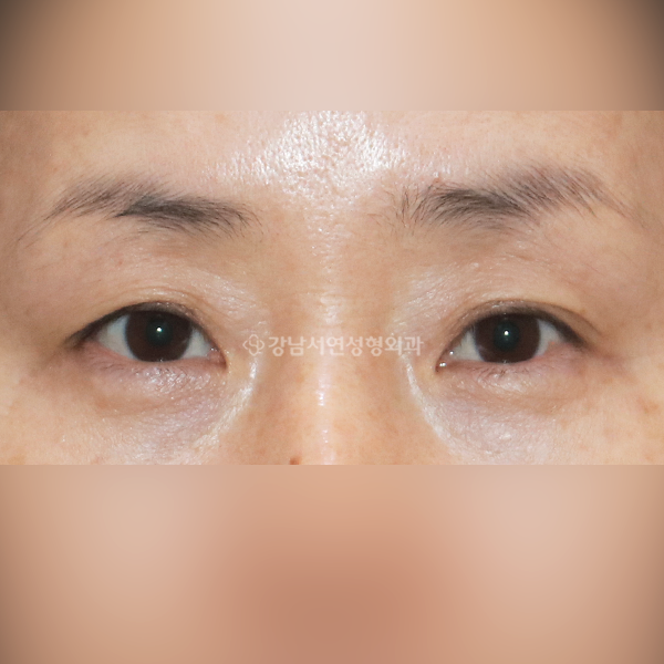상안검+뒤밑트임 BEFORE