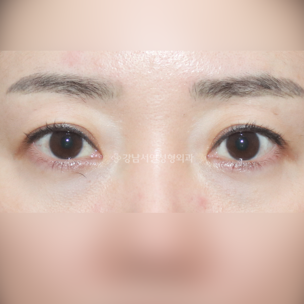 상안검 BEFORE