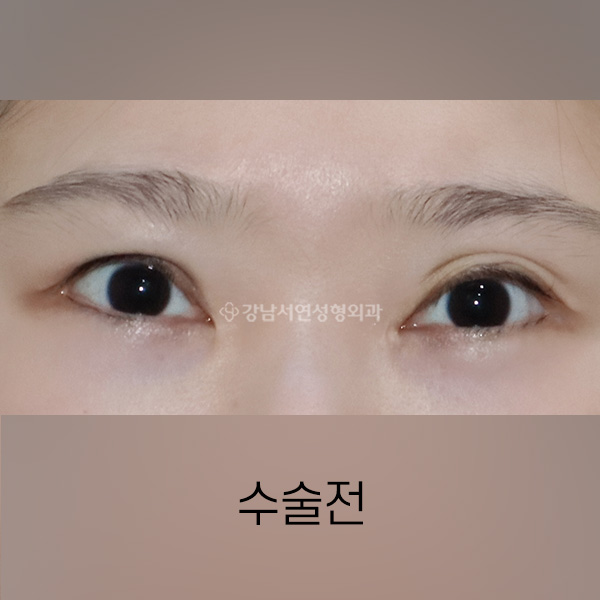 양쪽 퇴축수술 + 겹주름 개선 BEFORE