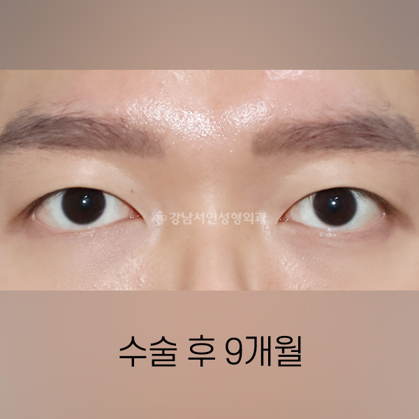 남자 무쌍(속쌍)수술 AFTER