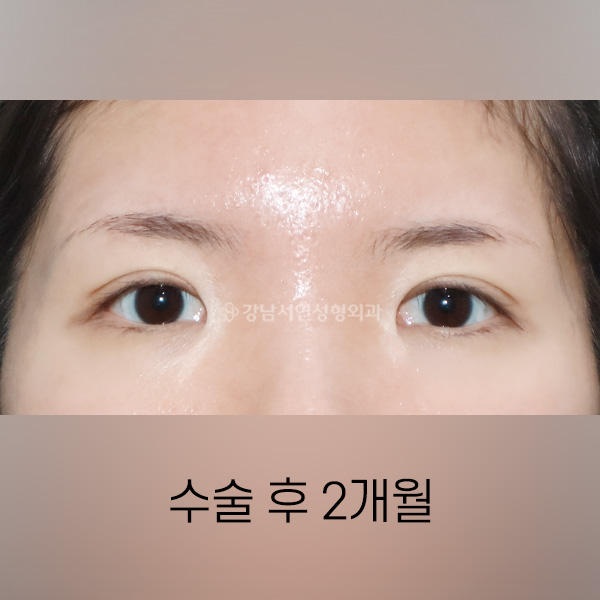쌍꺼풀 풀림 교정 AFTER