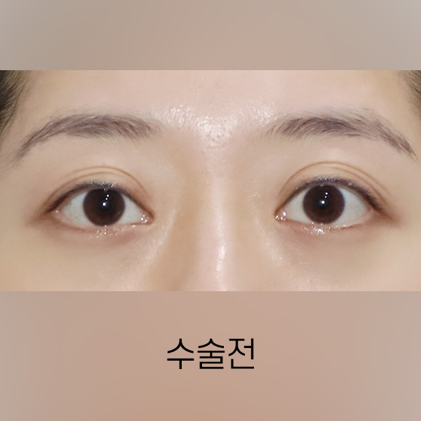 퇴축수술 BEFORE