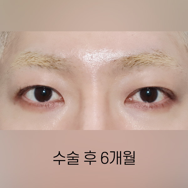 남자 쌍꺼풀 낮추기 AFTER
