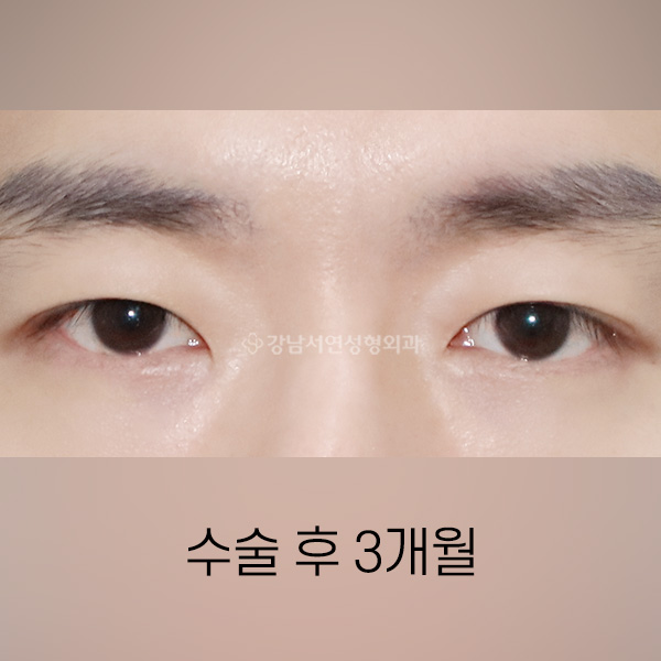 남자 절개쌍꺼풀 AFTER