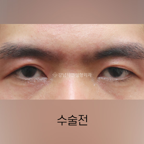 남자 쌍꺼풀 낮추기 BEFORE