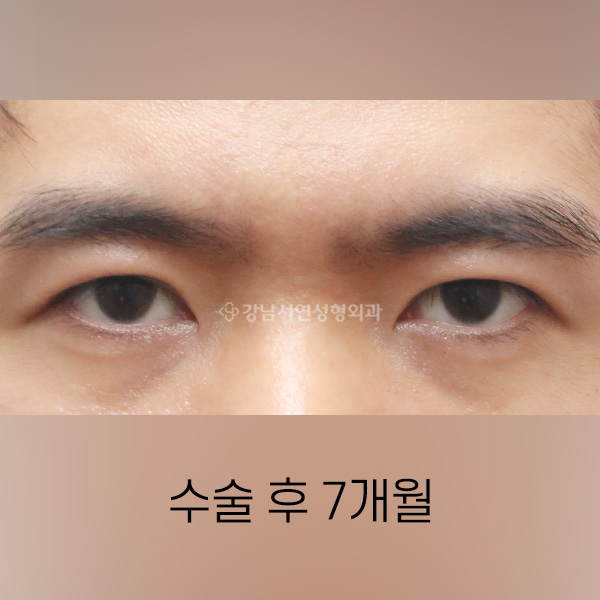 남자 쌍꺼풀 낮추기 AFTER