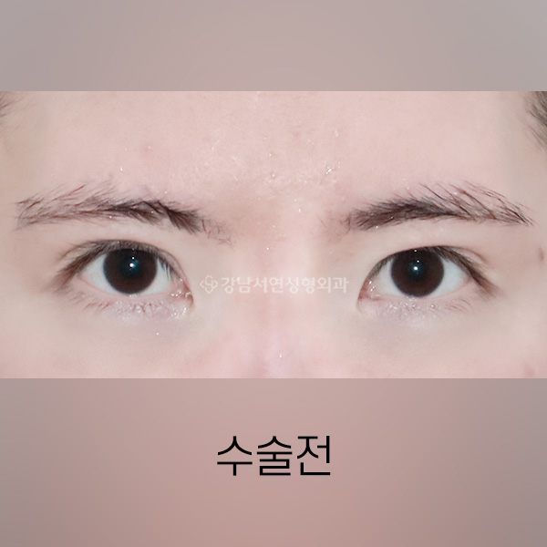 퇴축수술 BEFORE