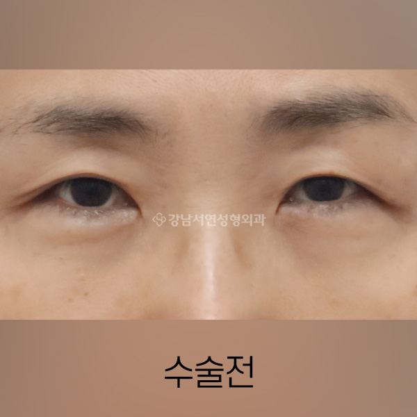 상안검 + 눈밑지방재배치 BEFORE