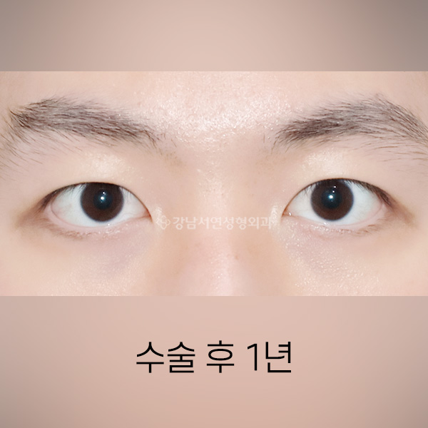 남자 절개쌍꺼풀 AFTER