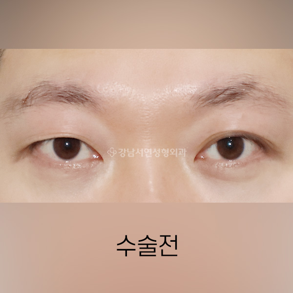 남자쌍꺼풀 낮추기 BEFORE