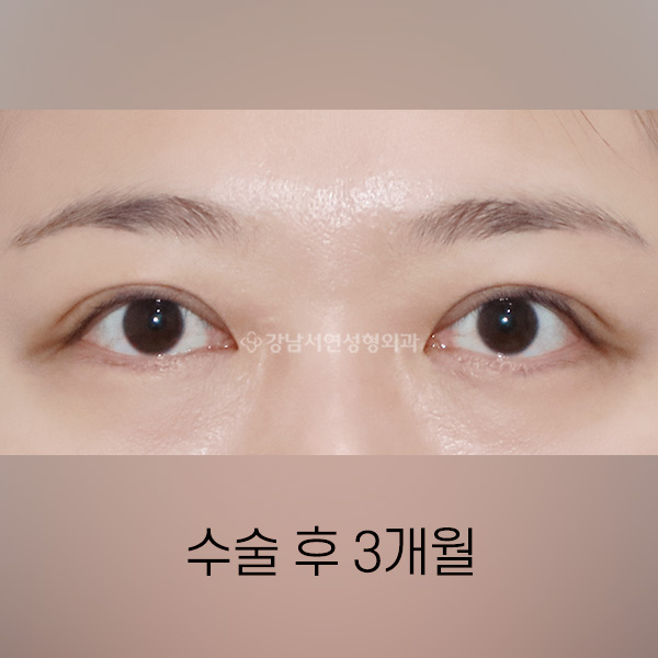 절개쌍꺼풀 AFTER