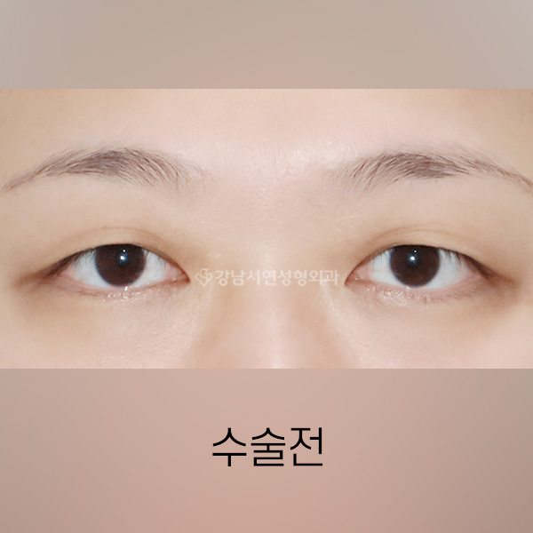 절개쌍꺼풀 BEFORE