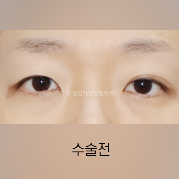 절개쌍꺼풀 BEFORE