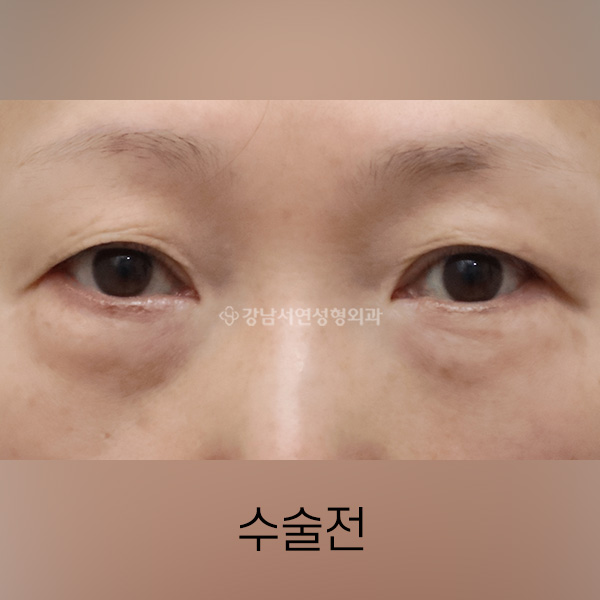 중년눈성형 BEFORE