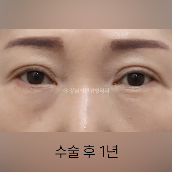 중년눈성형 AFTER