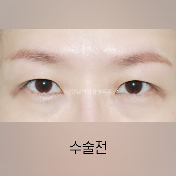 절개쌍꺼풀 재수술 BEFORE