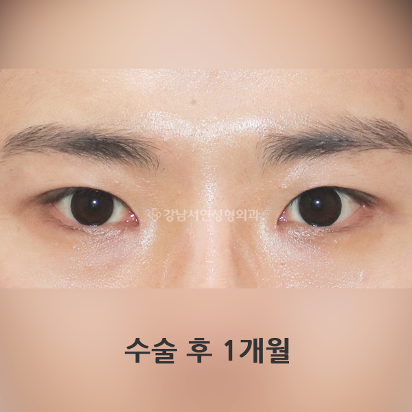 남자눈매교정 AFTER