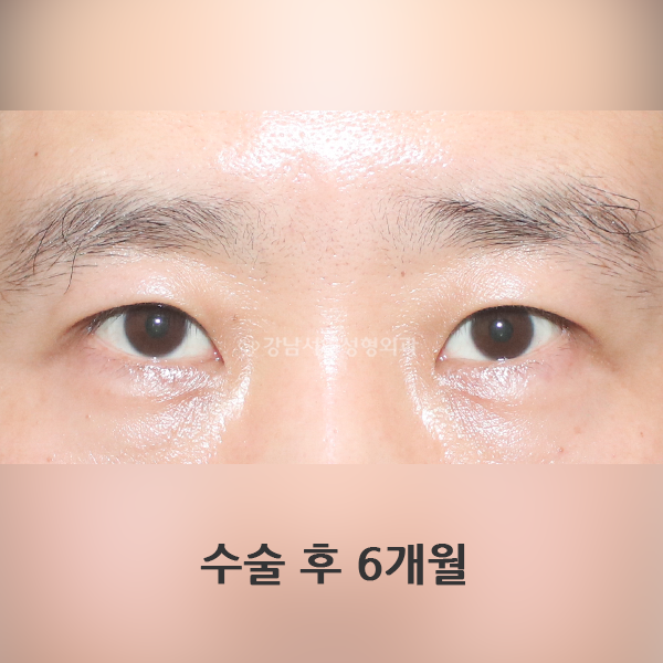 남자눈매교정 AFTER
