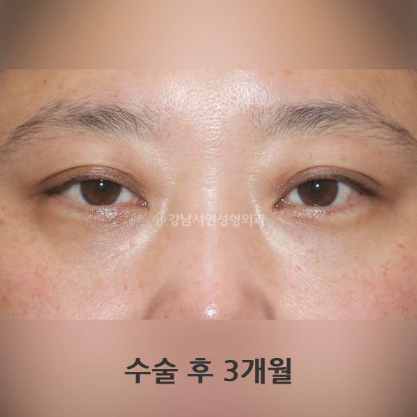 눈밑지방재배치 AFTER