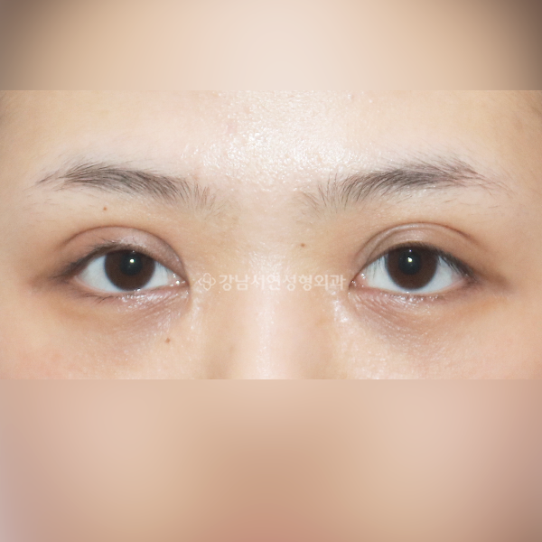 쌍꺼풀재수술 겹주름 교정(2주차) BEFORE