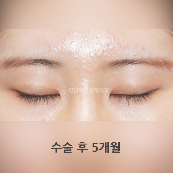 두줄따기 라인 낮추기 흉터 AFTER