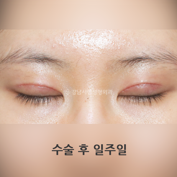 두줄따기 라인 낮추기 흉터 BEFORE