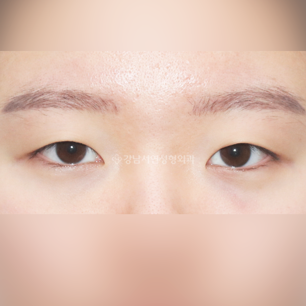 절개쌍꺼풀+앞트임 BEFORE