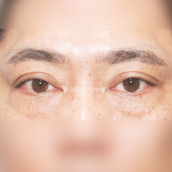 쌍꺼풀 없애기(낮추기) BEFORE