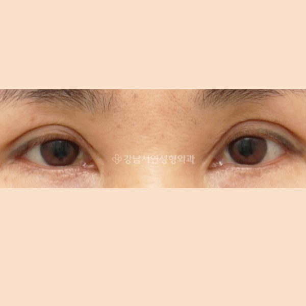 앞트임 복원 BEFORE