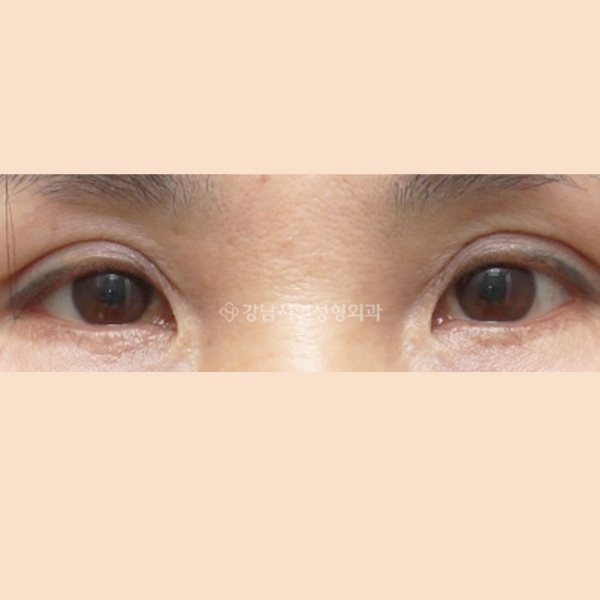 앞트임 복원 AFTER