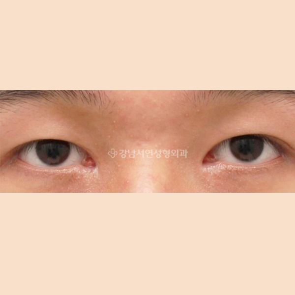 앞트임 복원 BEFORE