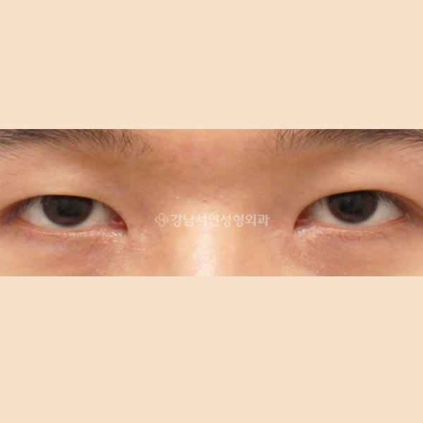 앞트임 복원 AFTER