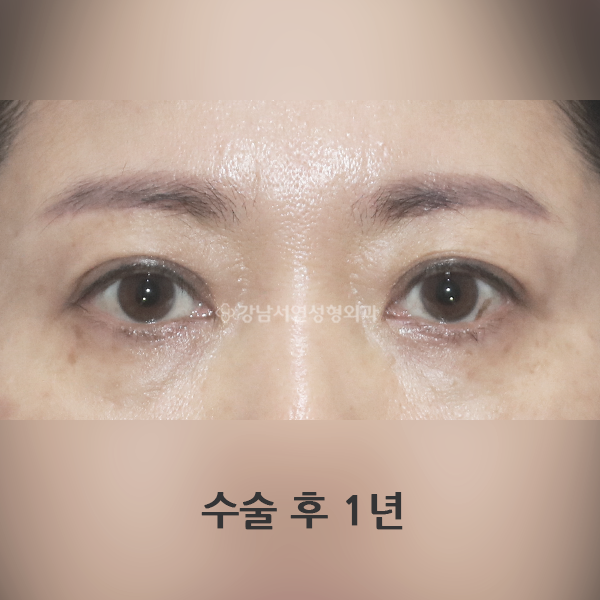 눈썹하거상 AFTER