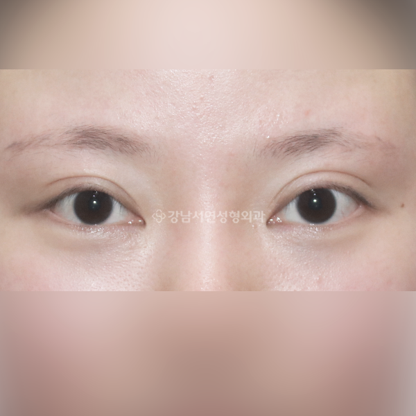 라인 낮추기 BEFORE